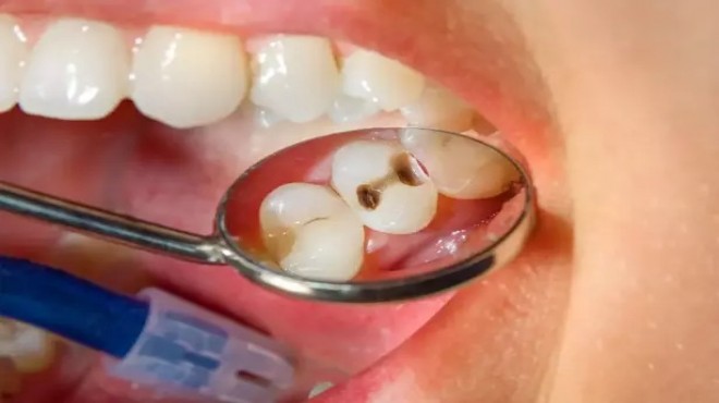Uzmanı açıkladı: Çürük süt dişleri sürekli dişleri de çürütüyor!