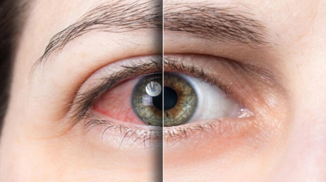 Viral enfeksiyonlar göz sağlığını etkiliyor!