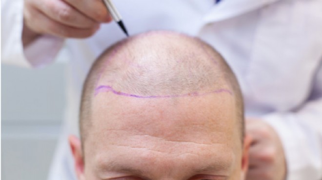  Saç ekim merkezlerinin yarısı doktorsuz  iddiası