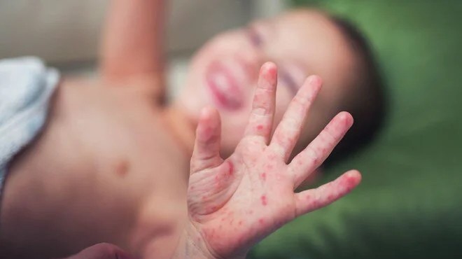 DSÖ den kızamık uyarısı... 22 milyon bebek aşı olmadı!
