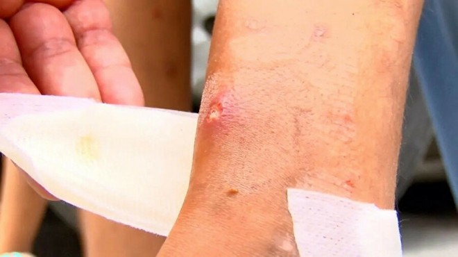 Sivrisinek paniği: Çocuklarda yaralar oluştu!