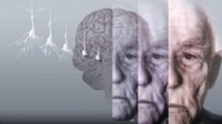 Uzmanı açıkladı: Demans ile Alzheimer aynı hastalık değil