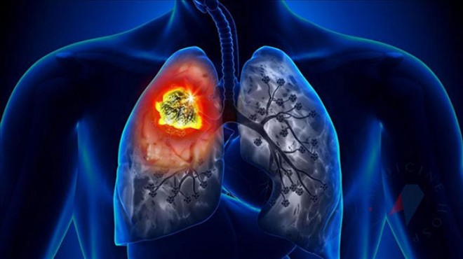 Uzmanı açıkladı: Akciğer kanseri artıyor!